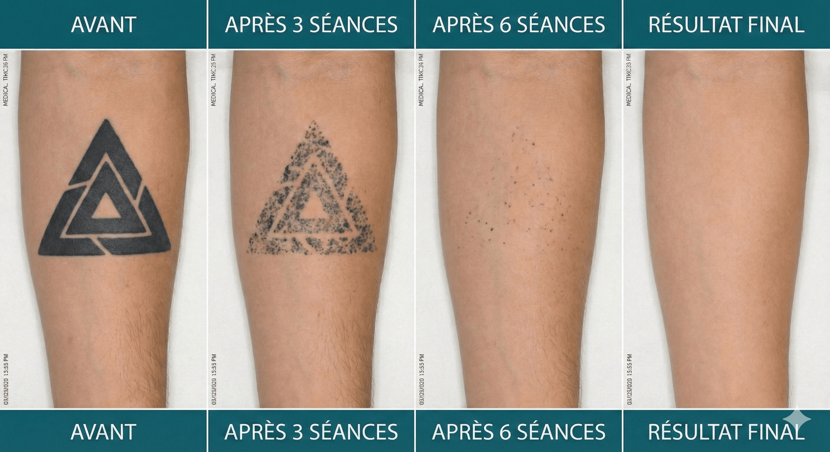 Résultats avant après détatouage laser