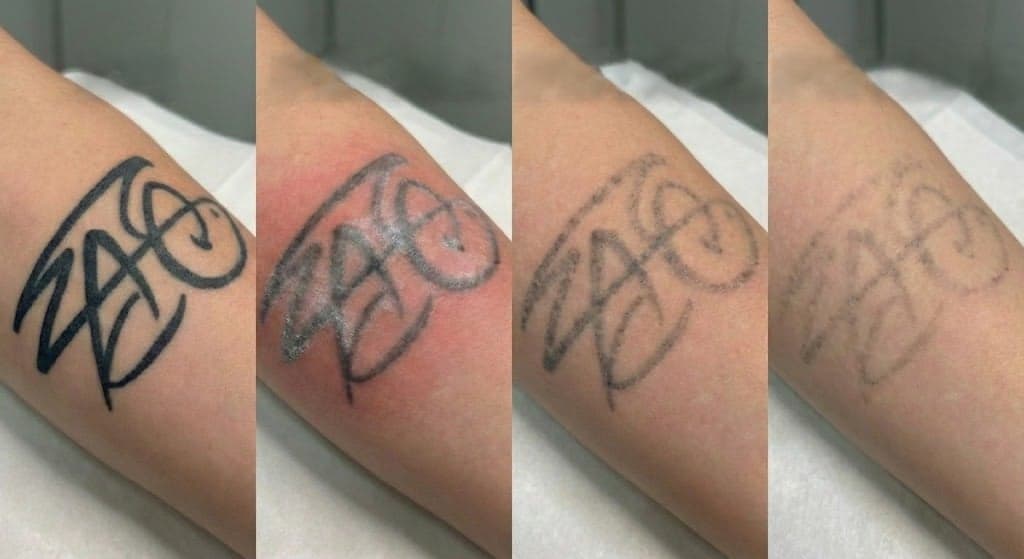 Évolution d'un détatouage laser sur 4 séances