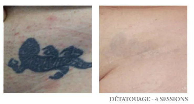 Détatouage bleu foncé - avant après