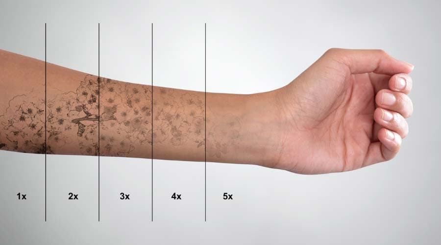 Progression détatouage laser à Saint-Chamond - Discovery Pico Plus