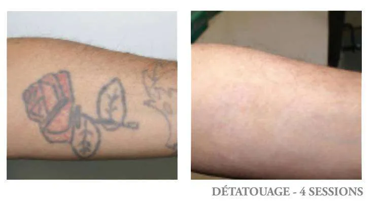 Détatouage papillon couleur - avant après