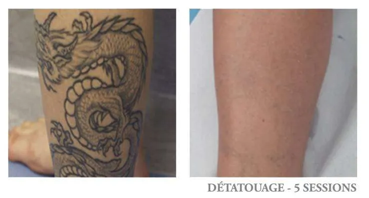 Détatouage dragon noir - avant après