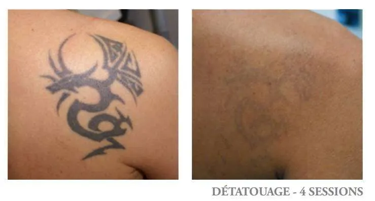 Détatouage tribal noir - avant après