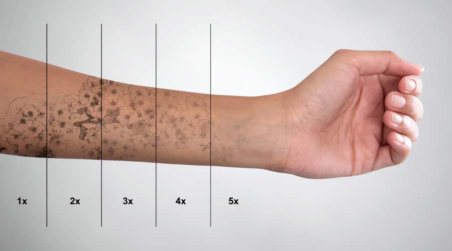 Progression détatouage laser à Limoux - Discovery Pico Plus